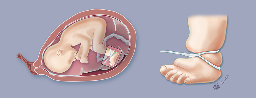 An illustration of amniotic band syndrome